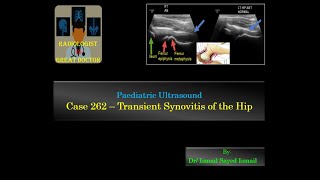 Ultrasound Case 262  Transient Synovitis of The Hip [upl. by Eekaz239]