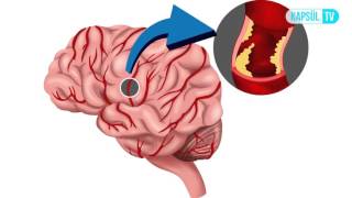 Beyin Kanaması Geçiren Hasta Nasıl Tedavi Edilir [upl. by Kemme379]