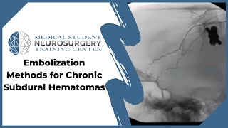 Embolization Methods for Chronic Subdural Hematomas [upl. by Hgielar]