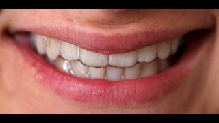 Clear Aligner  Erfahrungen mit unsichtbaren Zahnspangen wwwzahnspangende [upl. by Araccat]