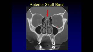 Imaging of the Paranasal Sinuses 1 [upl. by Altaf442]