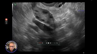 antral follicle count [upl. by Irt]