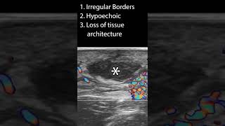 Characteristics of an Abscess pocus ultrasound [upl. by Livia]