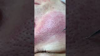 Big Cystic Acne Blackheads Extraction Blackheads amp Milia Whiteheads Removal Pimple Popping [upl. by Eirellav503]