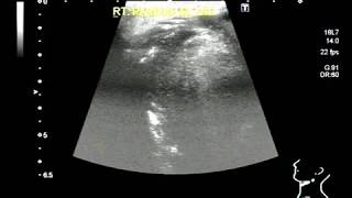 Ultrasound Video showing a small and illdefined mass in Parotid gland A rare case [upl. by Ahseiyt]