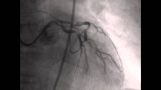 Coronary angiography CAG [upl. by Thamora]