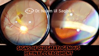 Clinical Signs Of Rhegmatogenous Retinal Detachment [upl. by Mohandas]