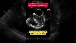 TEE Mid Esophageal Four Chamber with LVOT 5 chamber echocardiography [upl. by Dicky]