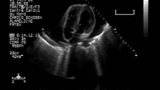 echocardiogram massive2pericardial effusion with cardiac tamponade4chambers view [upl. by Anne]