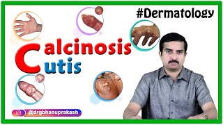 Calcinosis cutis  Dermatology clinicalessentials [upl. by Ybab]