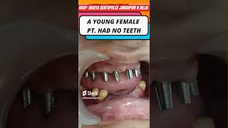 quotBasal Full Mouth Implants A Permanent Solution for Denture Wearersquot shorts shortvideo [upl. by Alsi442]