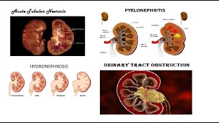 Pathology Urogenital  Tubular Disease amp Pyelonephritis amp Hydronephrosis amp Urinary Tract Obstruction [upl. by Naginnarb]