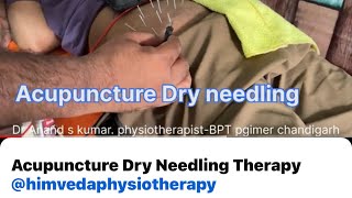 Acupuncture Dry Needling Therapy himvedaphysiotherapy [upl. by Kinata546]