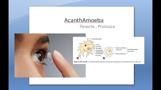 Ophthalmology 121 a AcanthAmoeba Keratitis Pseudo Dendrites eye cornea Contact lens PHMB [upl. by Eustashe]