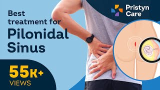 Best Treatment for Pilonidal Sinus  Pilonidal Sinus [upl. by Ledua725]