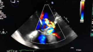 ASD Primum  TEE  Color Doppler  Echo Clip [upl. by Eugaet256]