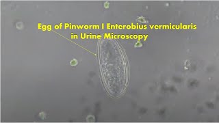 Egg of Pinworm in Urine Microscopy Enterobius vermicularis [upl. by Edelsten]