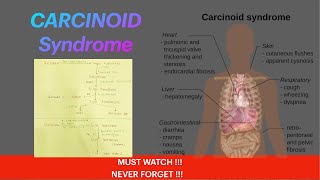 Carcinoid Syndrome  Causes  Symptoms  Diagnosis  Treatment  Carcinoid Tumor Serotonin [upl. by Bondy]