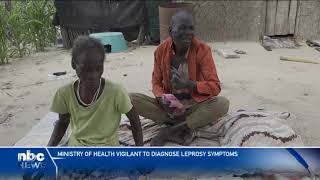 Ministry of Health vigilant to diagnose leprosy symptoms  nbc [upl. by Blader503]