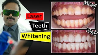 Teeth Whitening With Laser  Fastest amp Safest way [upl. by Ventura]