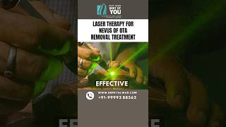 Laser Therapy for Nevus of OTA Removal Treatment  Nevus of OTA Treatment in Delhi  Dr PK Talwar [upl. by Wei17]