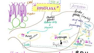 Ménètriers disease Pathophysiology [upl. by Goldia]