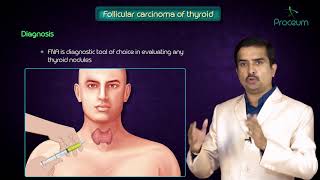 Thyroid neoplasms part 2  Follicular carcinoma of thyroid   Endocrine pathology [upl. by Richardson115]