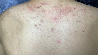 ACNE TREATMENT VU QUYNH MI  Acne On Back FULL [upl. by Yslek]