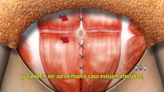 Abdominoplastia  Cirurgia Plástica do Abdome [upl. by Jemine18]