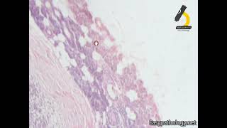 Pleomorphic adenoma [upl. by Amerak]