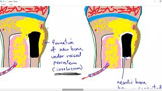 Systemic pathology 34  bone 4  osteomyelitis  DRSAMEH GHAZY [upl. by Ssidnac302]