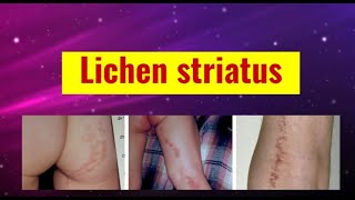 Lichen striatus overview causes features histology and management [upl. by Schonfeld798]