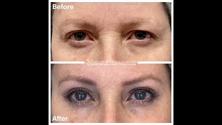 Before and After Endoscopic Brow Lift and Blepharoplasty Surgery [upl. by Alon]