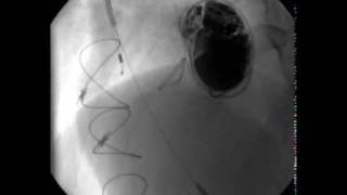 Spontaneous Thrombolysis of an Obstructed Mechanical Aortic Valve [upl. by Alica460]