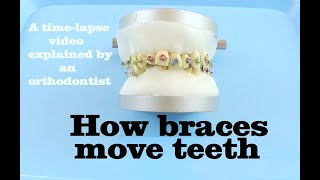 How they put braces on  13 years old patient  Tooth Time Family Dentistry New Braunfels Texas [upl. by Scarrow]