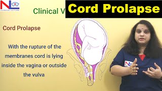 Cord Prolapse  Definition Risk factors Diagnosis  Nursing Lecture [upl. by Danzig]