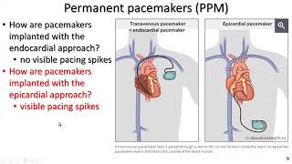 Permanent pacemakers and implantable cardiac defibrillators for exercise professionals the basics [upl. by Natsirk819]