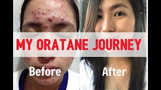 CYSTIC ACNE lifechanging Solution  ORATANE  Before amp After [upl. by Nellaf]