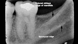 Dental Radiographic Anatomy [upl. by Neirad]