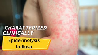 Epidermolysis bullosa  Symptoms and causes [upl. by Ecirted]