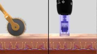 DERMAPEN SISTEMA DE REMODELACIÓN TISULAR [upl. by Eesyak]