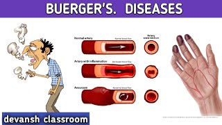 Buergers diseases  thromboangitis abliterans [upl. by Ande]