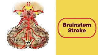 Brainstem Stroke Syndromes [upl. by Eelhsa]