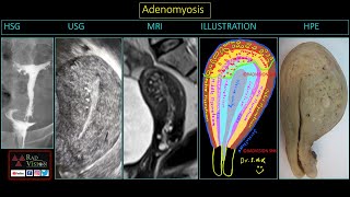 MUSA in AdenomyosisImaging and Illustrations [upl. by Htebazileyram]