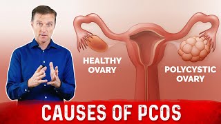 3 Causes of Polycystic Ovarian Syndrome PCOS amp High Androgens – Dr Berg [upl. by Bowman969]