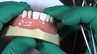 Placing two fusion anterior matrix bands on a single tooth [upl. by Anilat]