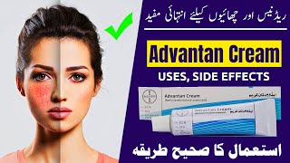 Advantan Cream Uses Benefits and Side Effects Discussed [upl. by Sakovich311]