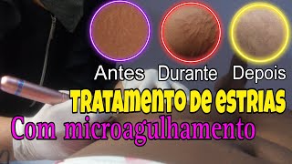 TRATAMENTO DE ESTRIAS COM MICROAGULHAMENTO [upl. by Jonas]