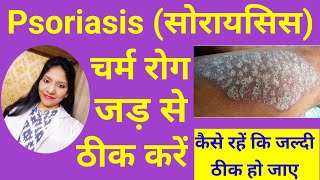 सोरायसिस का पूरा इलाज  Psoriasis Best homeopathic treatment in Hindi  Psoriasis skin disease [upl. by Elocim]