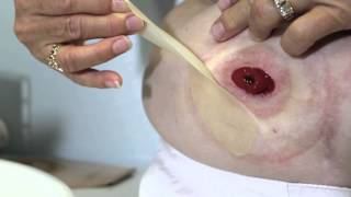 Applying and Removing Genairex Hydrocolloid Skin Barrier Strips [upl. by Laith]